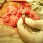 Sakit Appendix